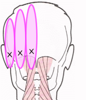 後頭部の痛む場所
